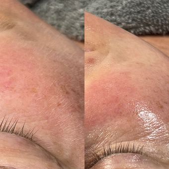 A cheek before and after dermaplaning, the fine surface hair gone and the skin left smooth and bright.